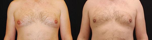 Lynn Chung, MD gynecomastia result — Puyallup, WA