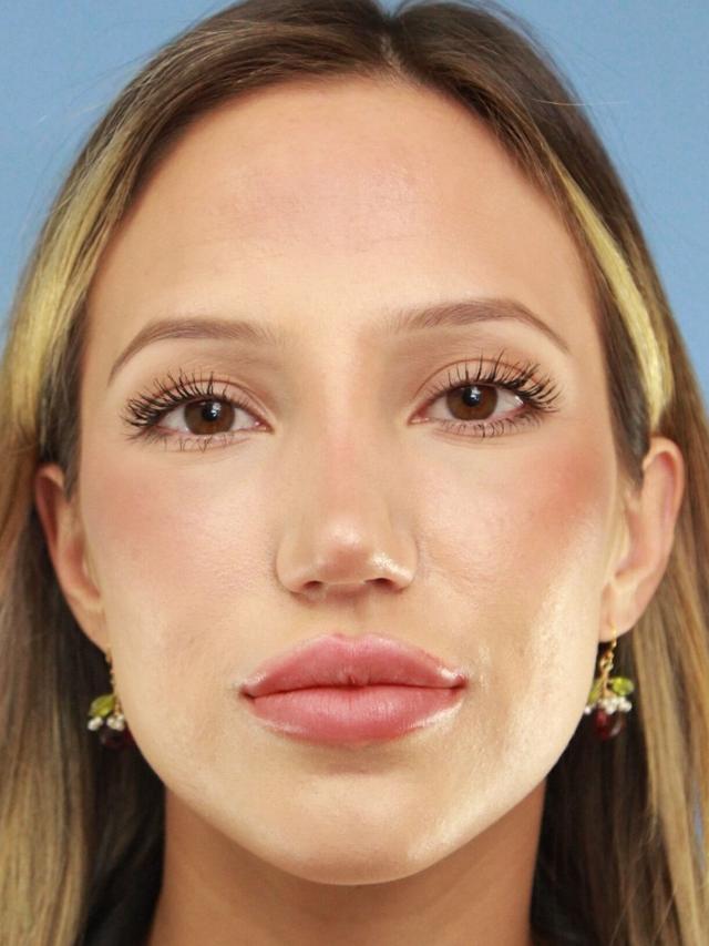 Lip Filler after at Platinum Plastic Surgery in Las Vegas, NV