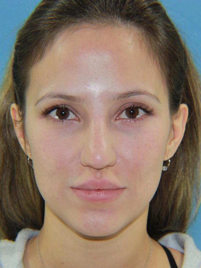 Lip Filler before at Platinum Plastic Surgery in Las Vegas, NV