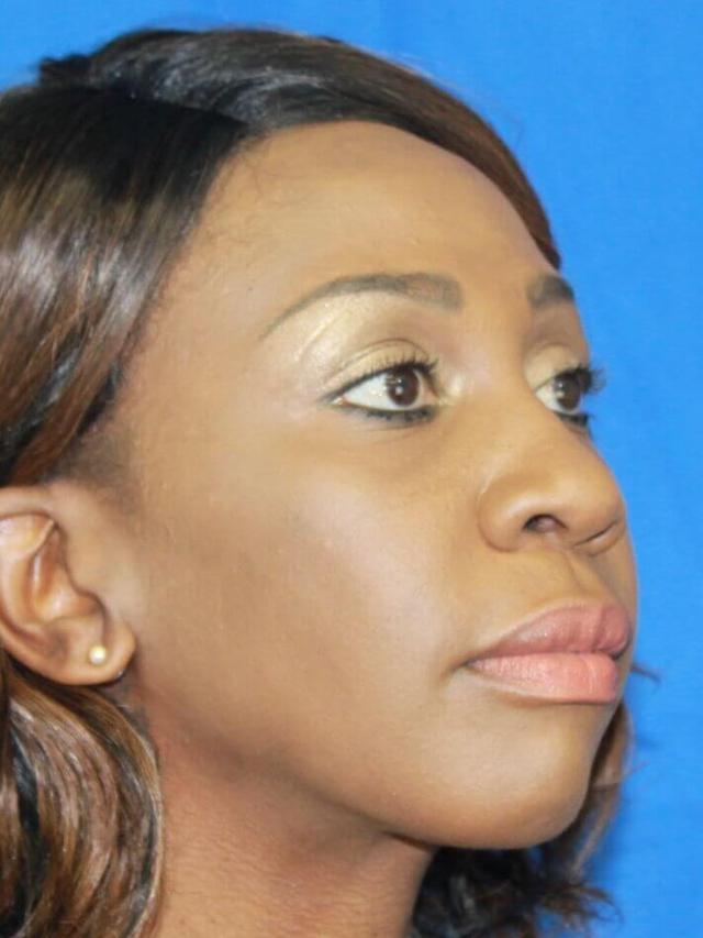 Rhinoplasty before at Platinum Plastic Surgery in Las Vegas, NV