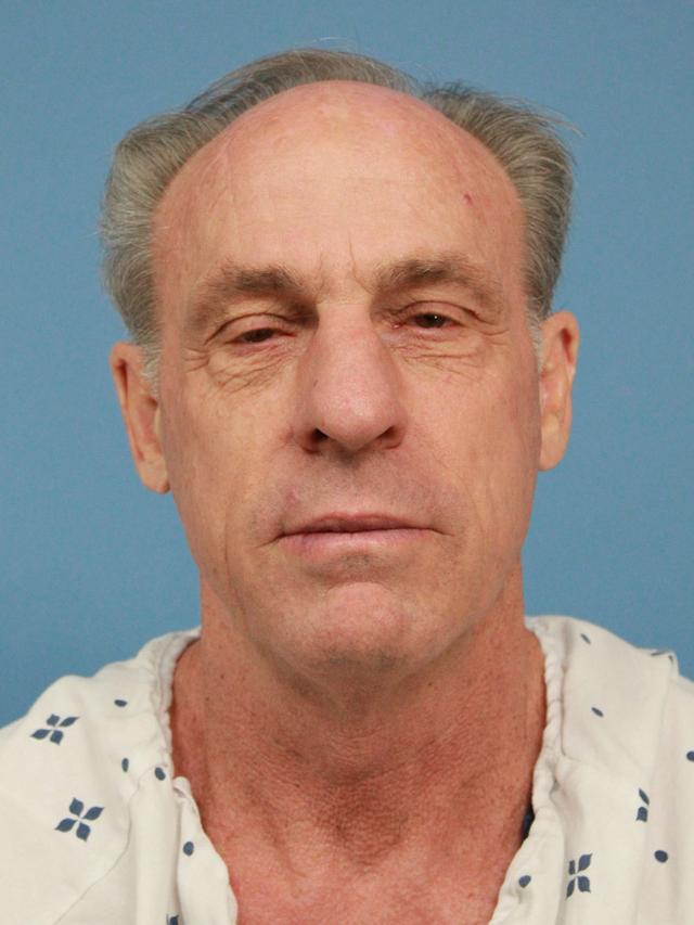 Facelift before at Platinum Plastic Surgery in Las Vegas, NV