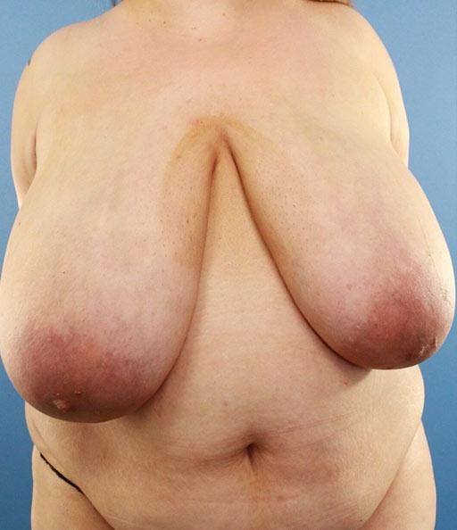 Breast Reduction before at Platinum Plastic Surgery in Las Vegas, NV