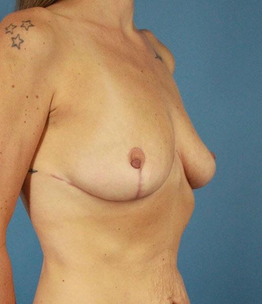 Platinum Plastic Surgery breast reduction after — Las Vegas, NV