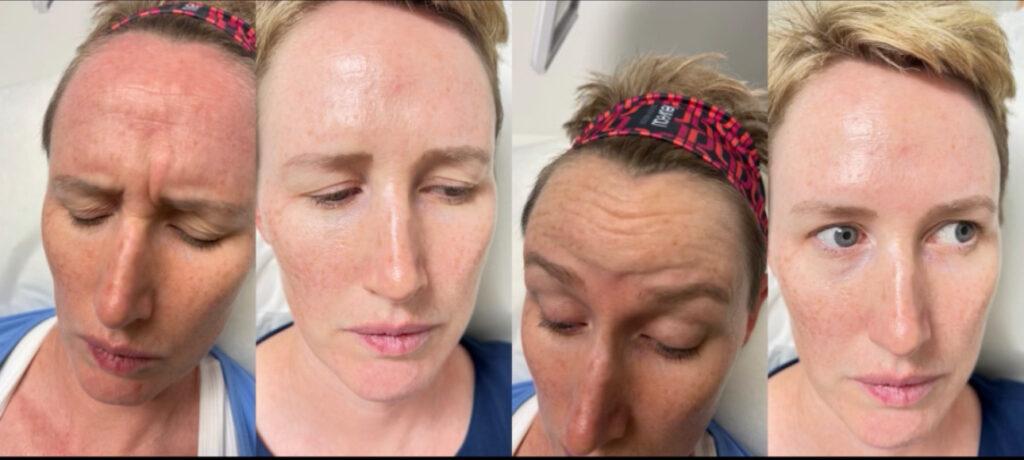 Estar MedSpa & Innovative Health Center botox result — Olney, MD