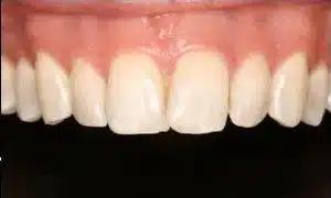 Smile by Design Dental Group veneers after — Irvine, CA