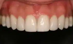 Dental Veneers before at Smile by Design Dental Group in Irvine, CA