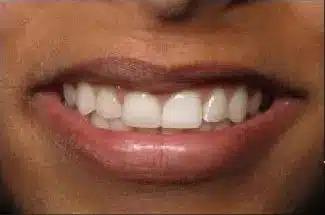 Smile by Design Dental Group veneers after — Irvine, CA