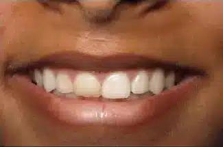 Dental Veneers before at Smile by Design Dental Group in Irvine, CA