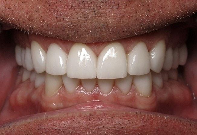 Smile by Design Dental Group smile makeover after — Irvine, CA