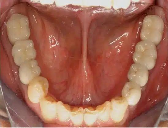 Dental Implants after at Smile by Design Dental Group in Irvine, CA