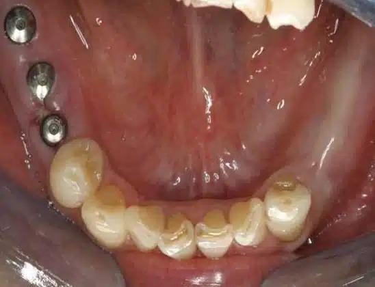 Dental Implants before at Smile by Design Dental Group in Irvine, CA