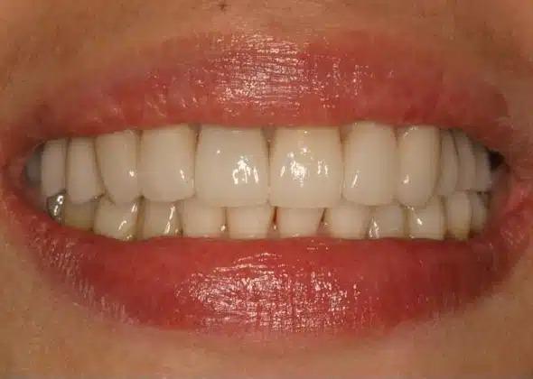Dental Implants after at Smile by Design Dental Group in Irvine, CA