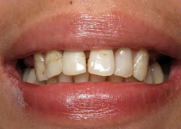 Dental Implants before at Smile by Design Dental Group in Irvine, CA