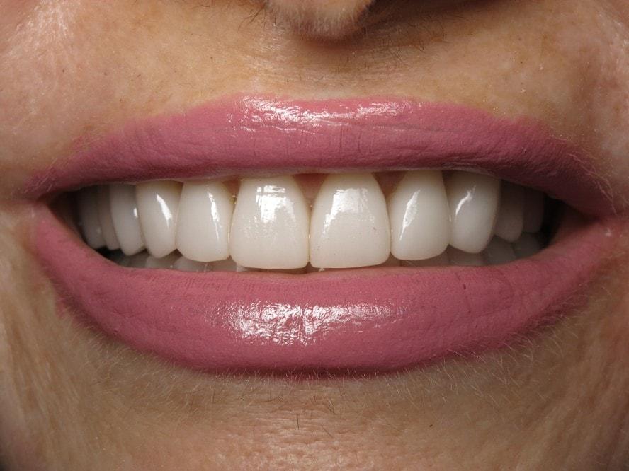 Smile by Design Dental Group veneers after — Irvine, CA