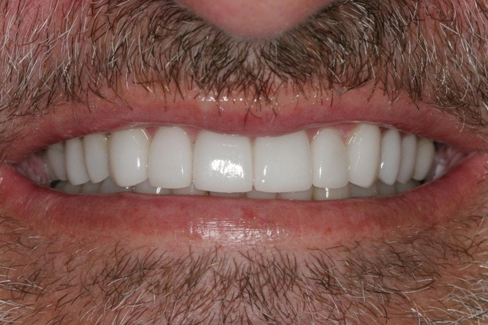 Smile by Design Dental Group veneers after — Irvine, CA
