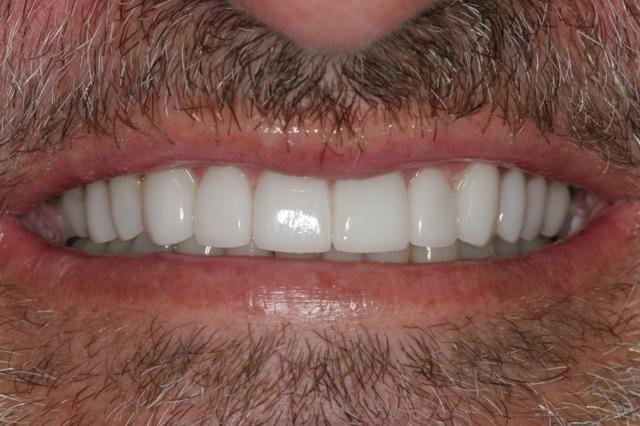 Dental Veneers after at Smile by Design Dental Group in Irvine, CA
