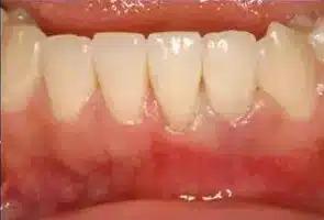 Smile by Design Dental Group dental implants after — Irvine, CA