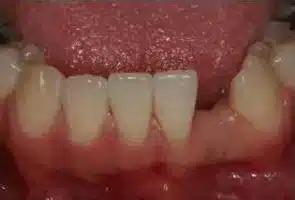 Dental Implants before at Smile by Design Dental Group in Irvine, CA