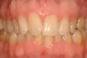 Dental Implants before at Smile by Design Dental Group in Irvine, CA