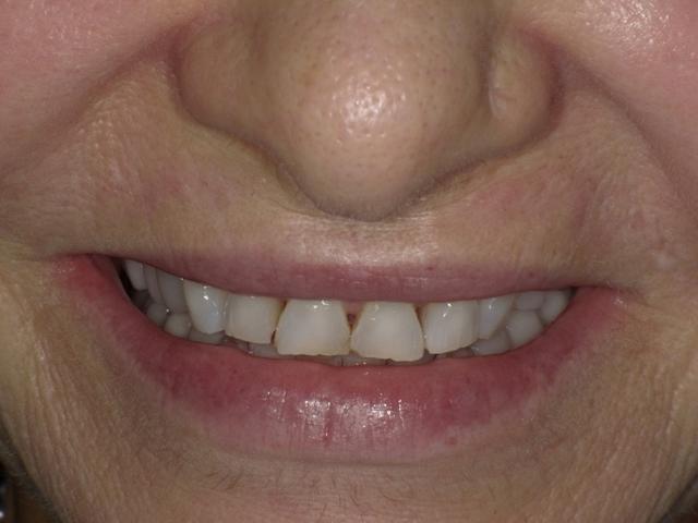 Dental Veneers before at Smile by Design Dental Group in Irvine, CA