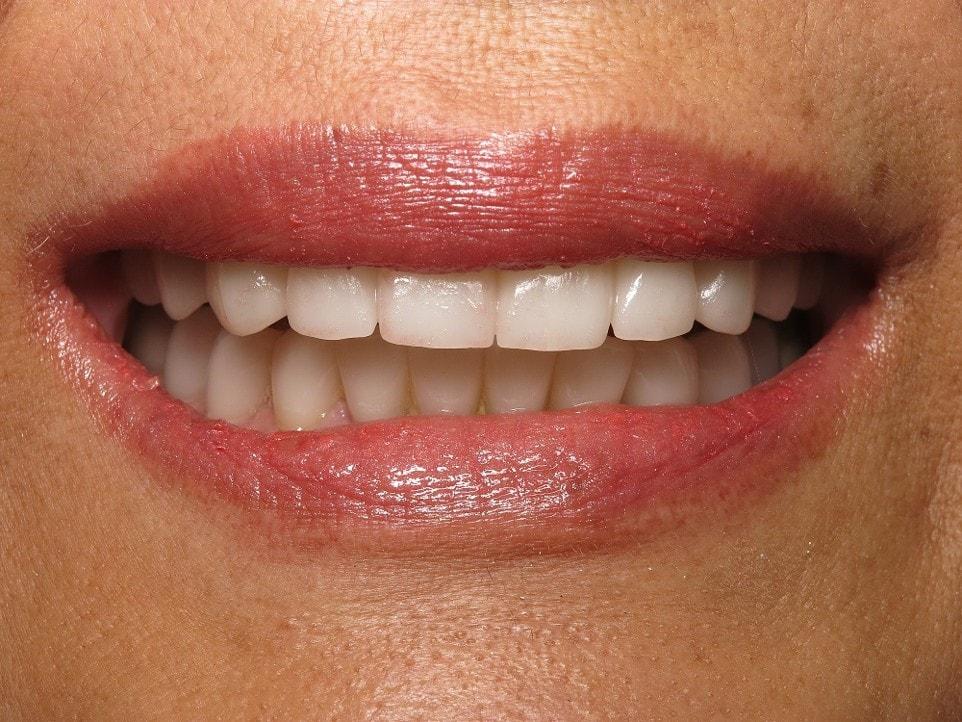Smile by Design Dental Group smile makeover after — Irvine, CA