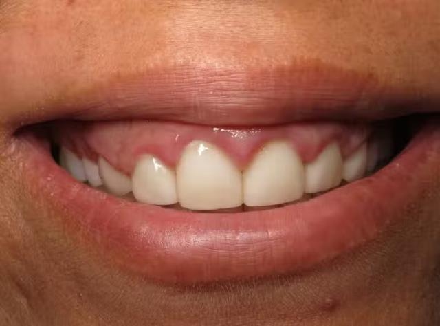 Dental Implants before at Smile by Design Dental Group in Irvine, CA