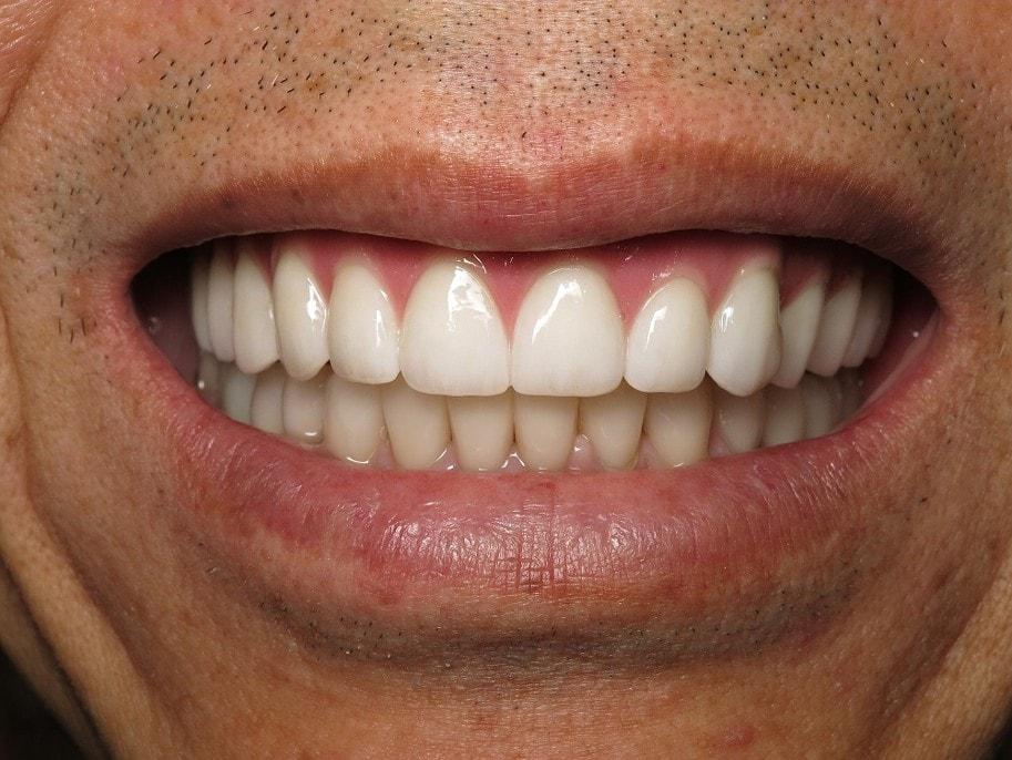 Smile by Design Dental Group smile makeover after — Irvine, CA