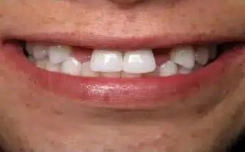 Dental Veneers before at Smile by Design Dental Group in Irvine, CA