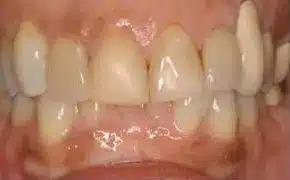 Dental Implants before at Smile by Design Dental Group in Irvine, CA