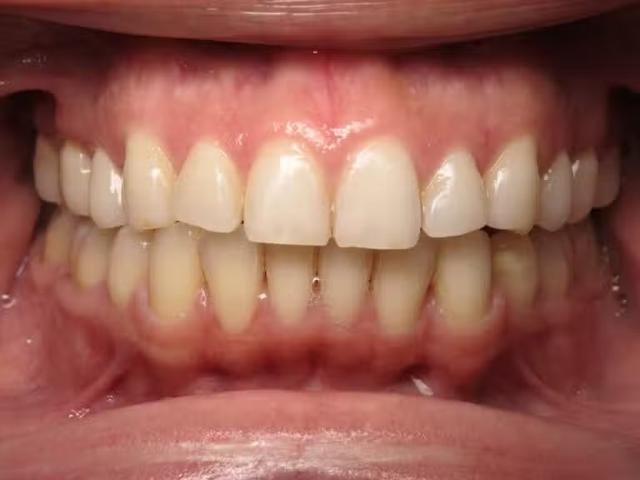 Dental Implants after at Smile by Design Dental Group in Irvine, CA