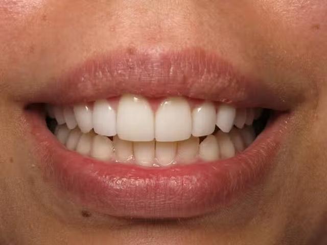 Dental Veneers after at Smile by Design Dental Group in Irvine, CA