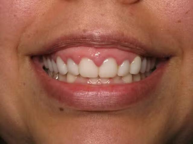 Dental Veneers before at Smile by Design Dental Group in Irvine, CA