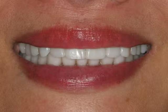 Dental Implants after at Smile by Design Dental Group in Irvine, CA