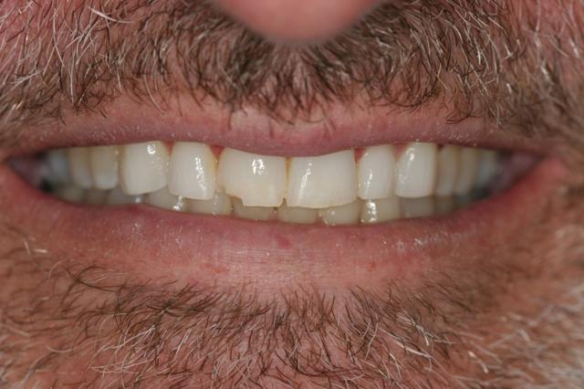 Dental Veneers before at Smile by Design Dental Group in Irvine, CA