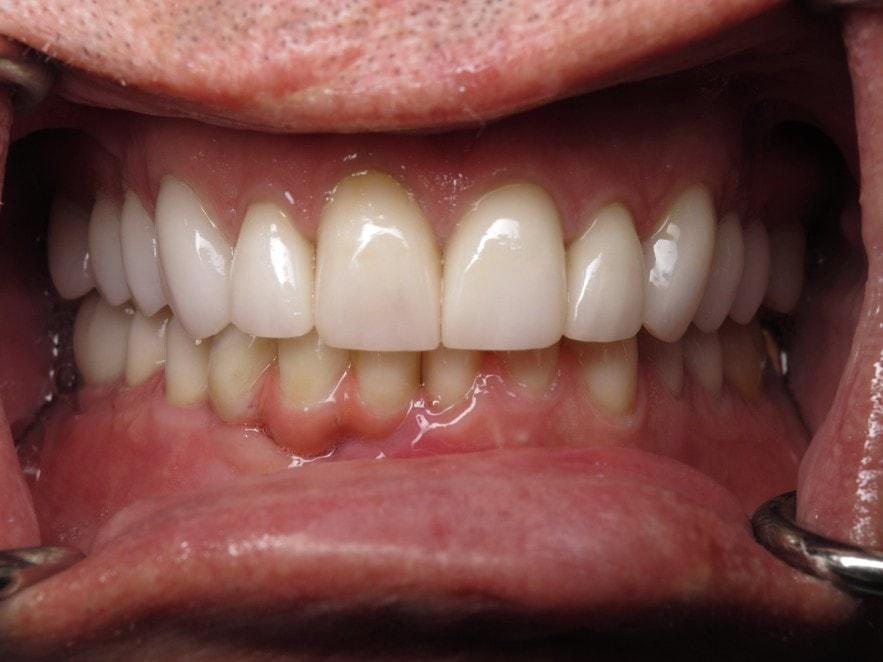 Smile by Design Dental Group smile makeover after — Irvine, CA