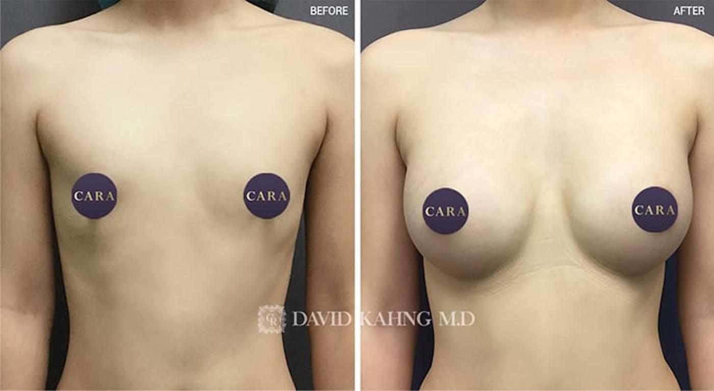 Cara Plastic Surgery breast augmentation result — Los Angeles, CA