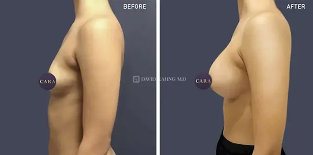 Breast Augmentation result at Cara Plastic Surgery in Los Angeles, CA