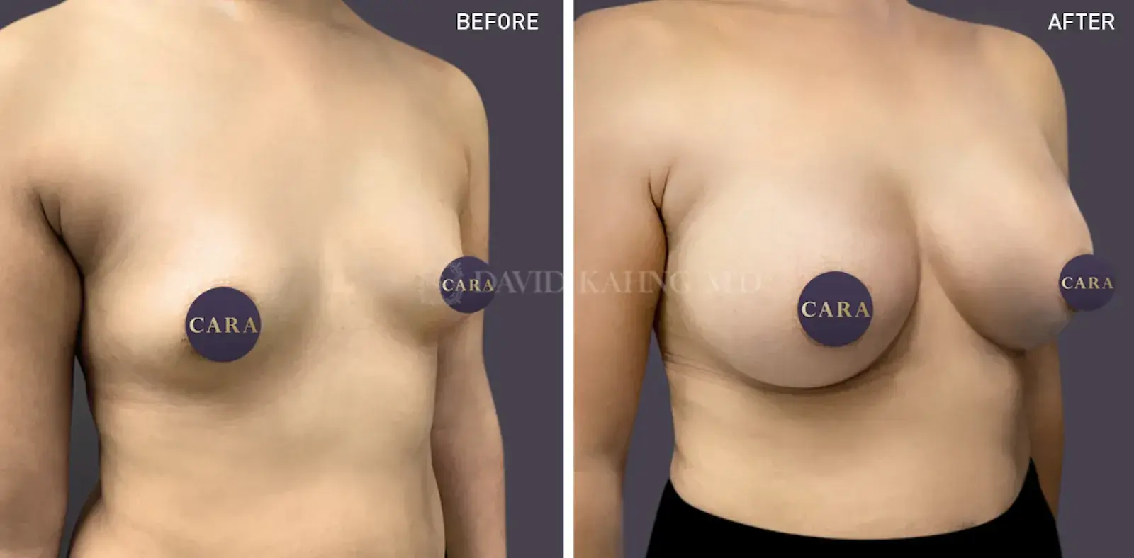 Cara Plastic Surgery breast augmentation result — Los Angeles, CA