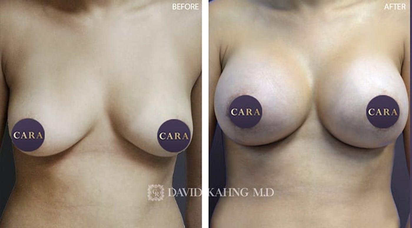 Cara Plastic Surgery breast augmentation result — Los Angeles, CA
