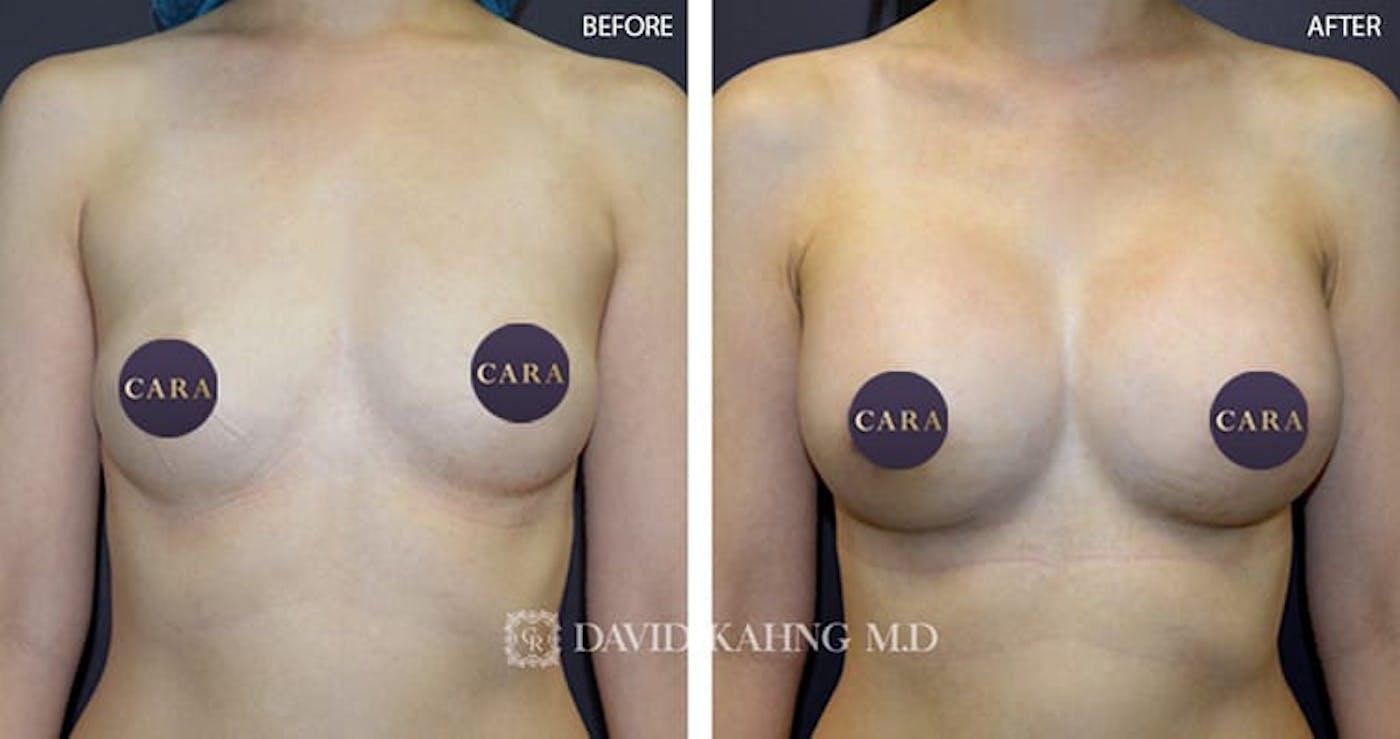 Cara Plastic Surgery breast augmentation result — Los Angeles, CA