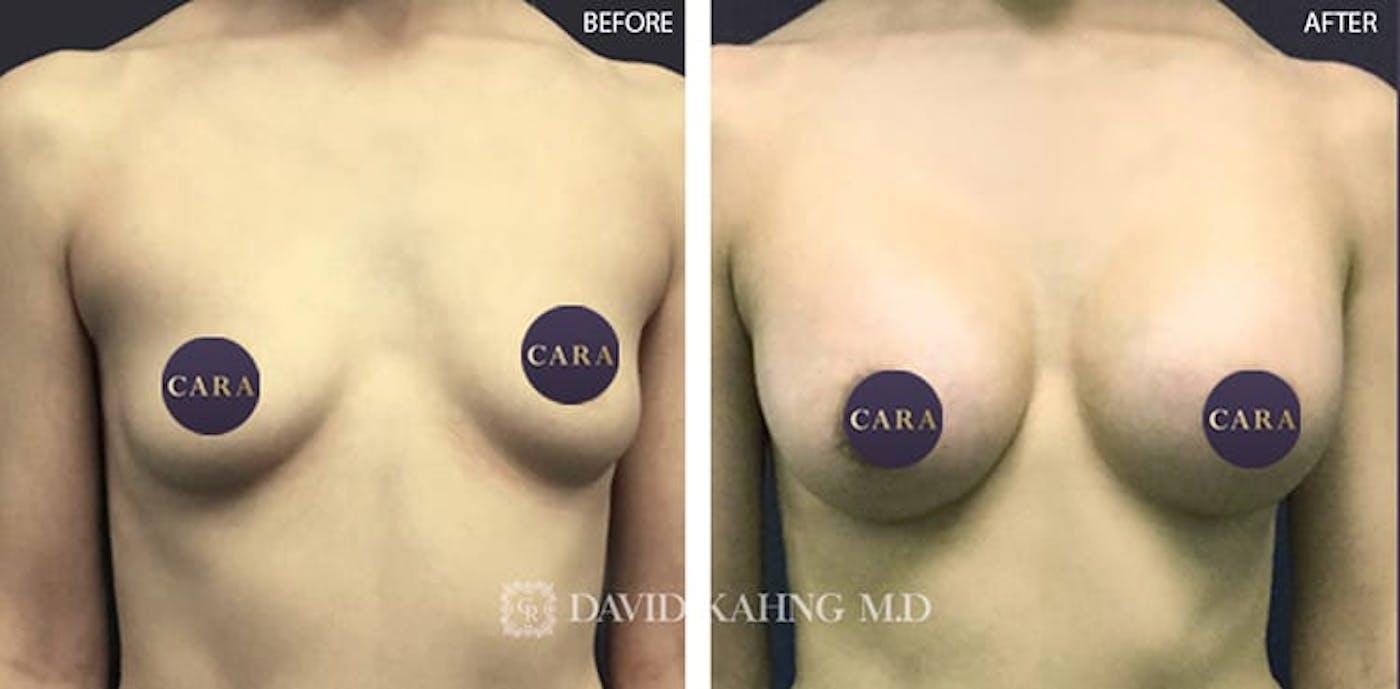 Cara Plastic Surgery breast augmentation result — Los Angeles, CA