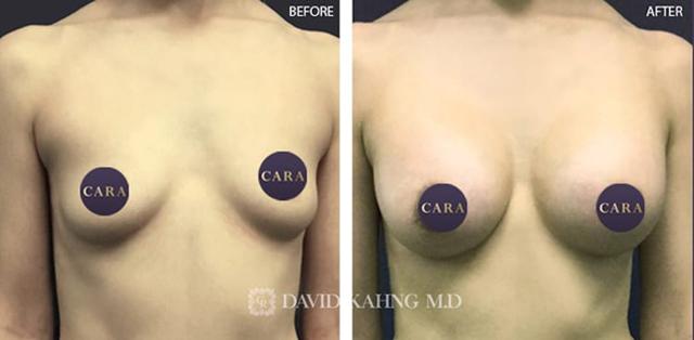 Breast Augmentation result at Cara Plastic Surgery in Los Angeles, CA