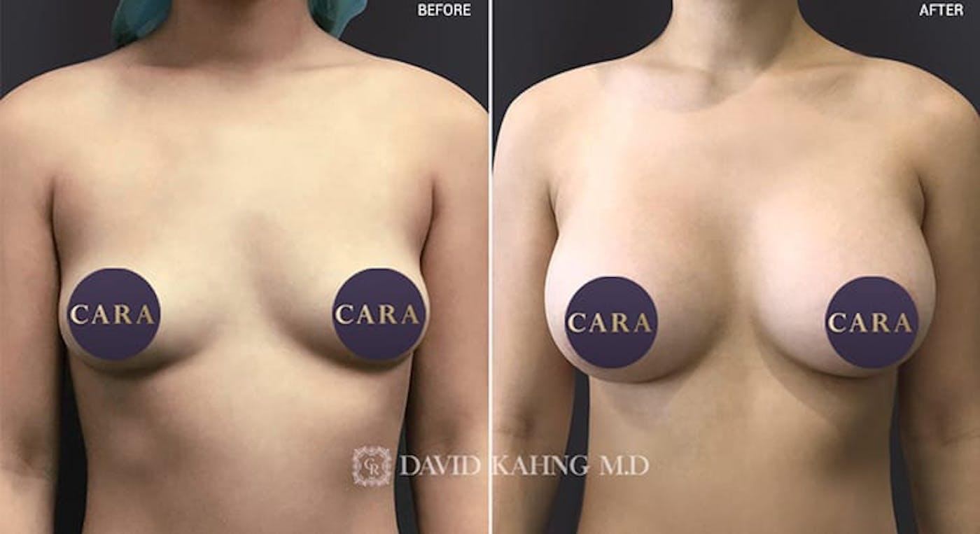Cara Plastic Surgery breast augmentation result — Los Angeles, CA