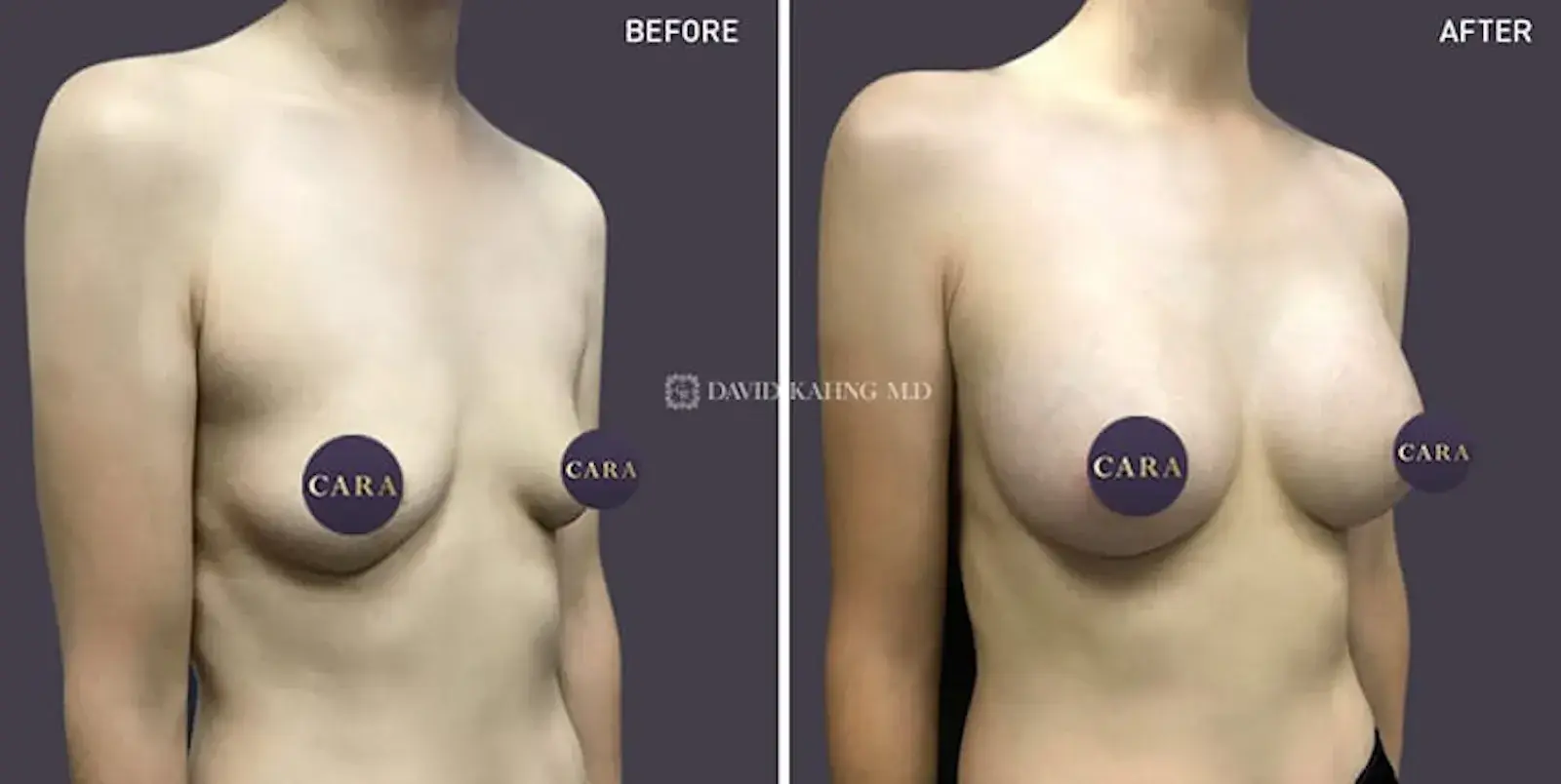 Cara Plastic Surgery breast augmentation result — Los Angeles, CA