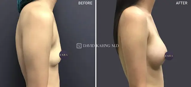 Fat Transfer Breast Augmentation result at Cara Plastic Surgery in Los Angeles, CA