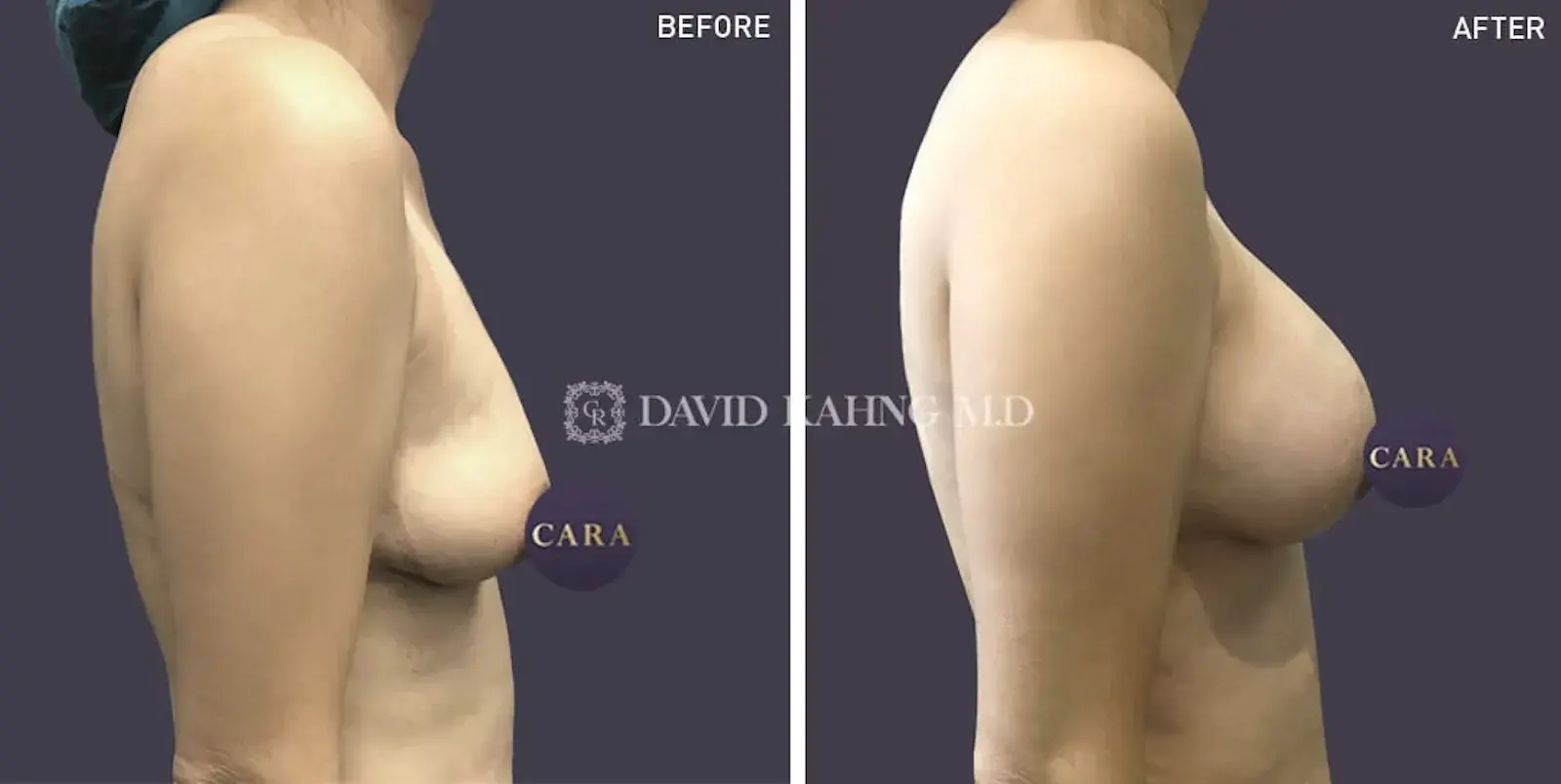 Cara Plastic Surgery breast augmentation result — Los Angeles, CA