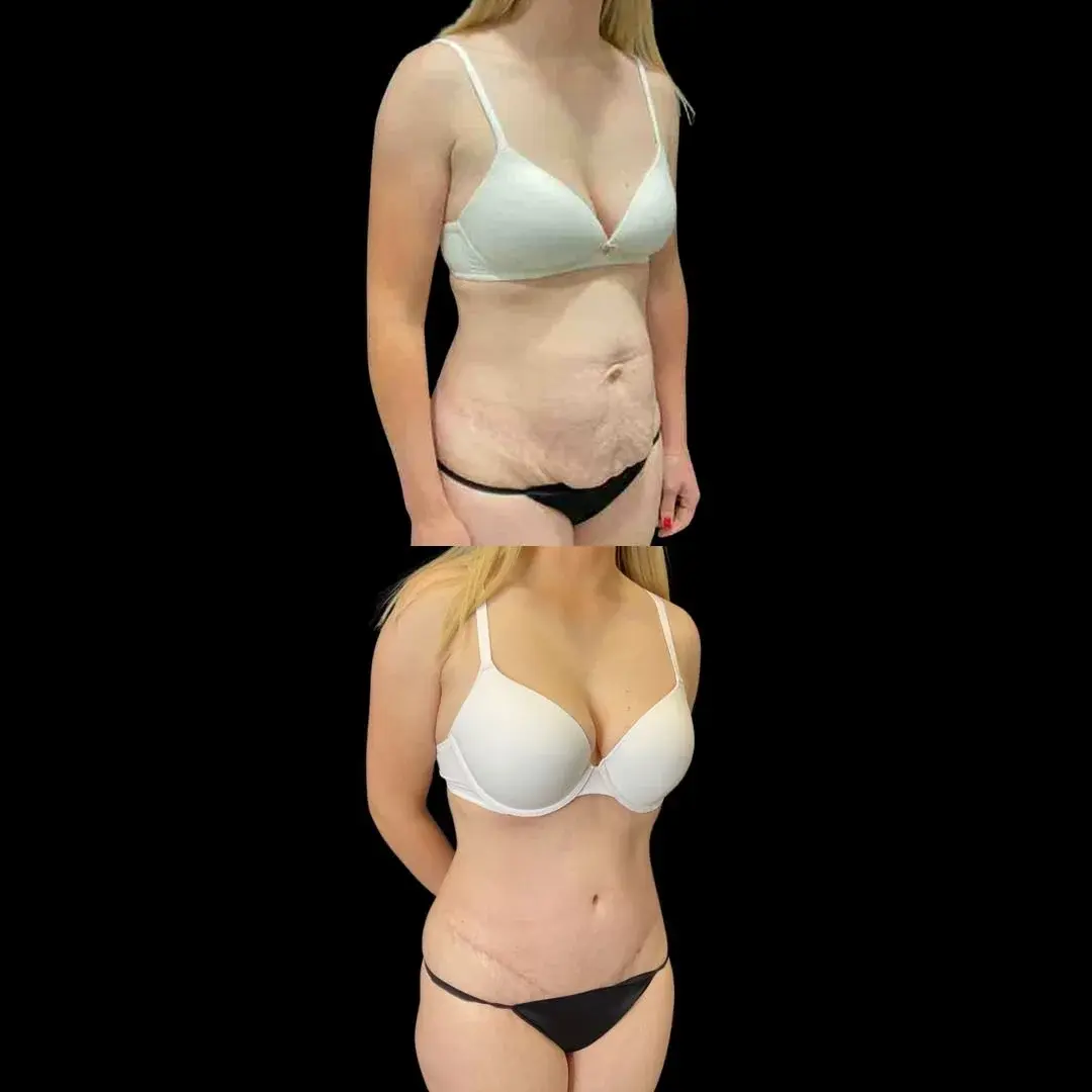 Real You Plastic Surgery tummy tuck result — American Fork, UT