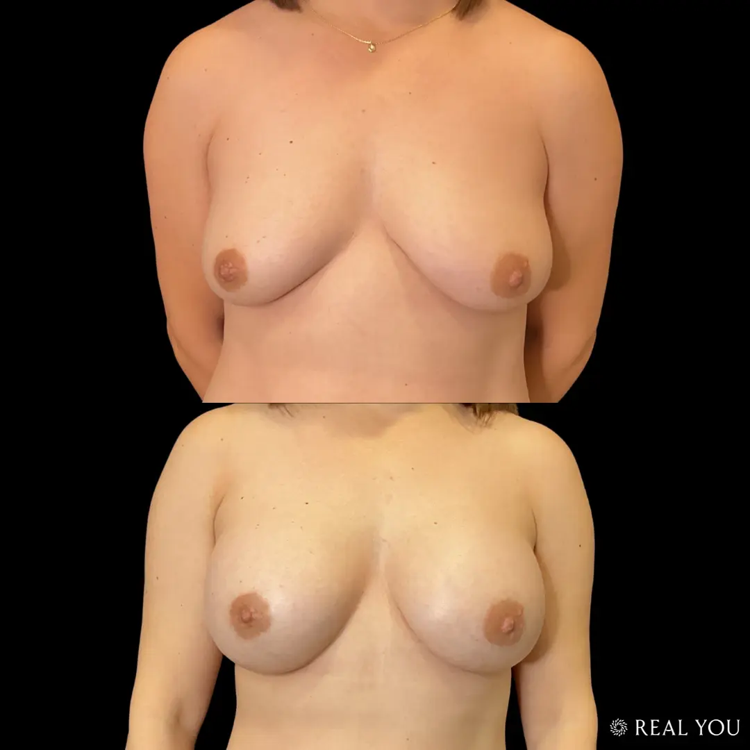 Real You Plastic Surgery breast augmentation result — American Fork, UT