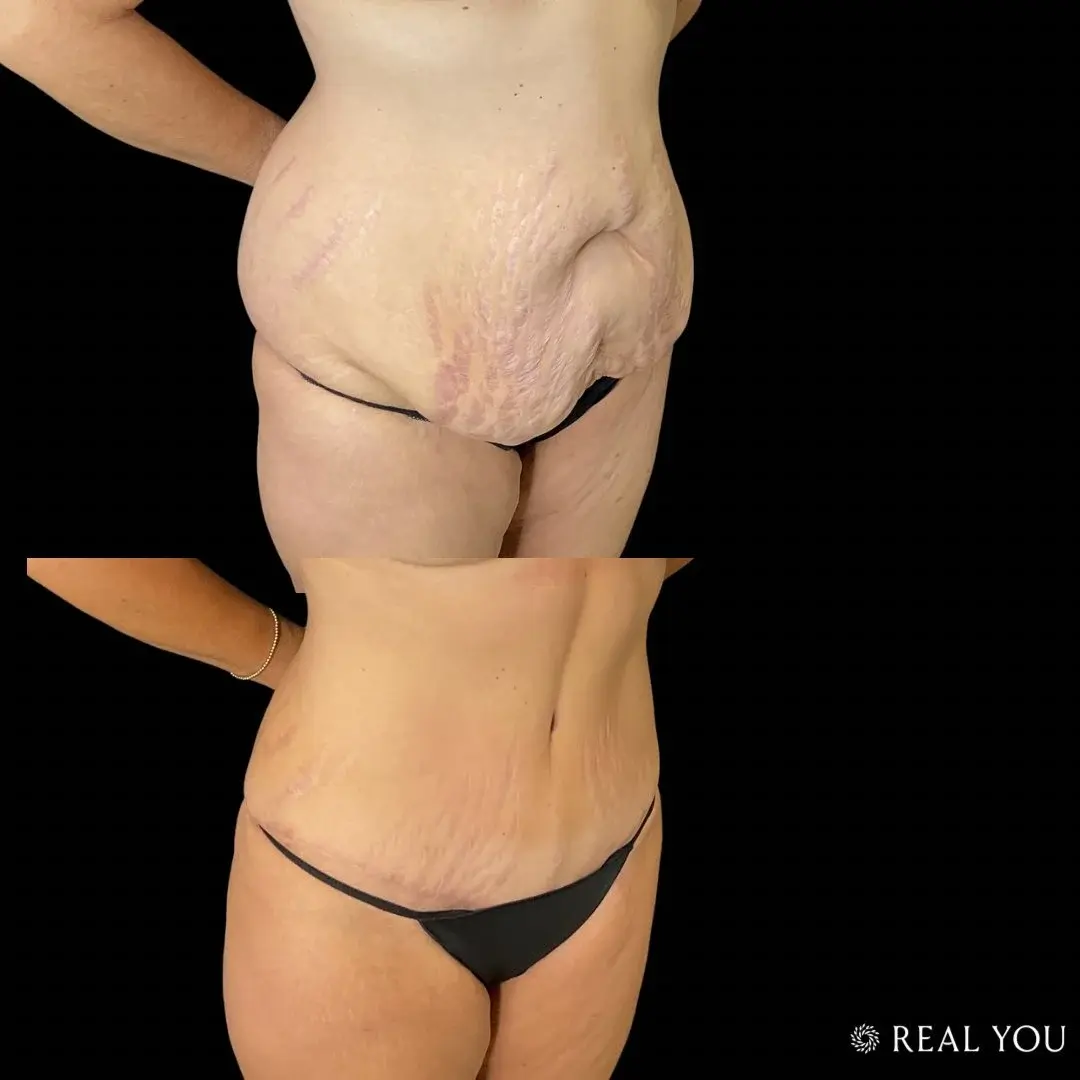 Real You Plastic Surgery result — American Fork, UT