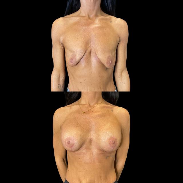 Breast Lift result at Real You Plastic Surgery in American Fork, UT